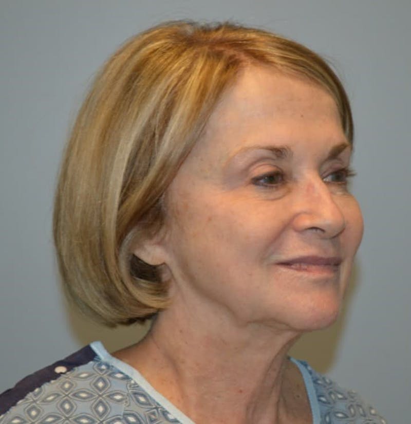 Surgical Lip Lift Before & After Gallery - Patient 922089 - Image 7