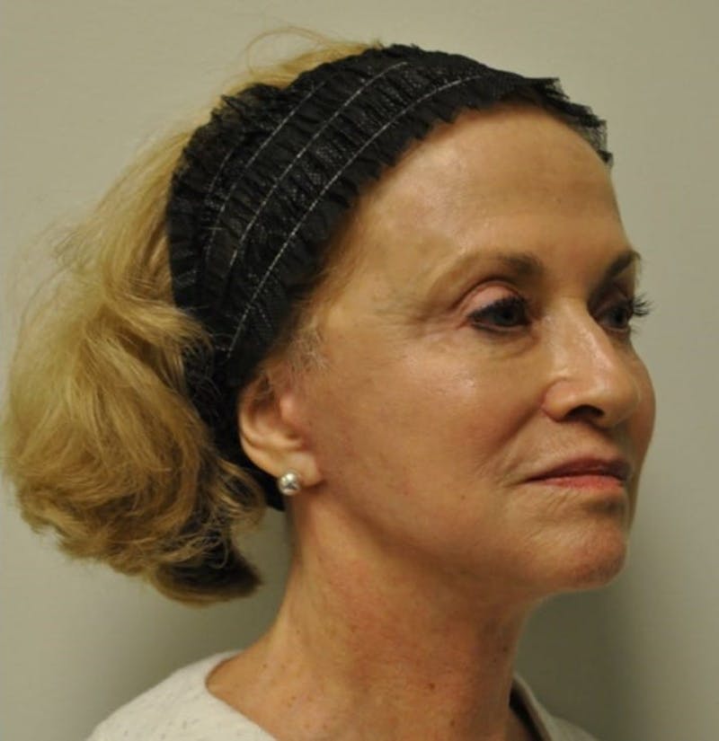Surgical Lip Lift Before & After Gallery - Patient 922089 - Image 8