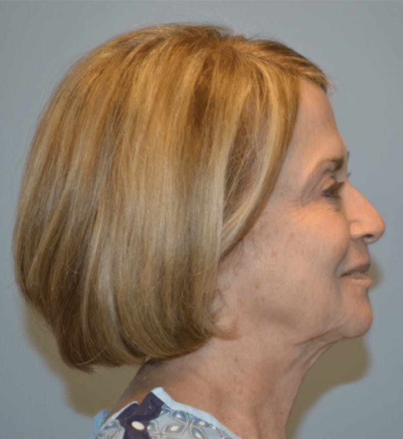 Surgical Lip Lift Before & After Gallery - Patient 922089 - Image 9
