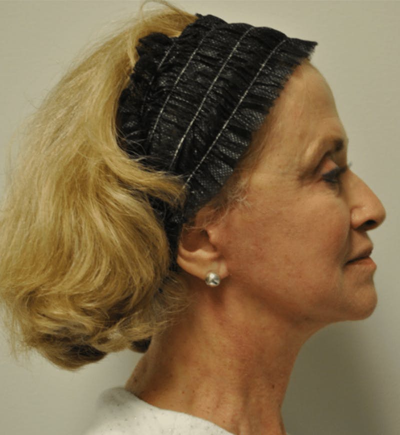 Surgical Lip Lift Before & After Gallery - Patient 922089 - Image 10