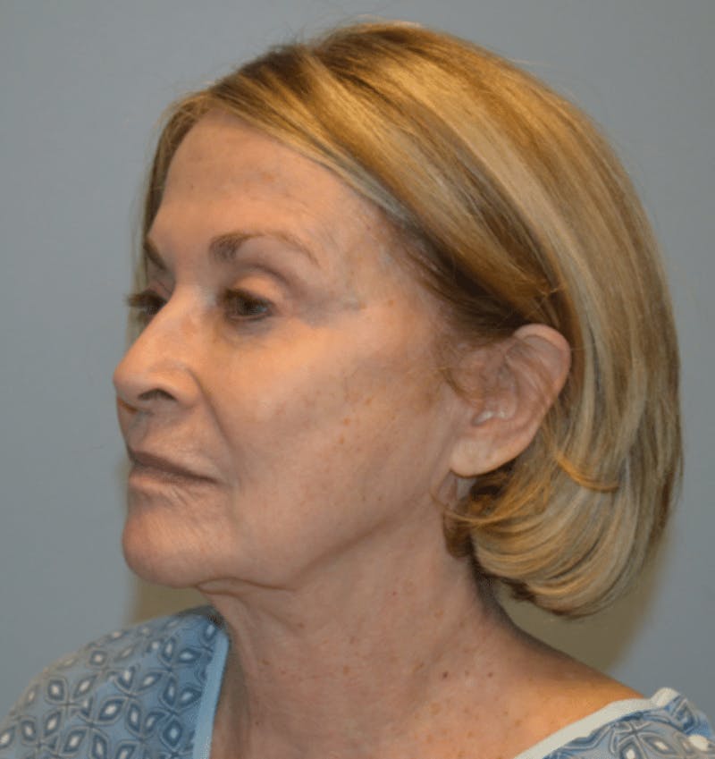Surgical Lip Lift Before & After Gallery - Patient 922089 - Image 3