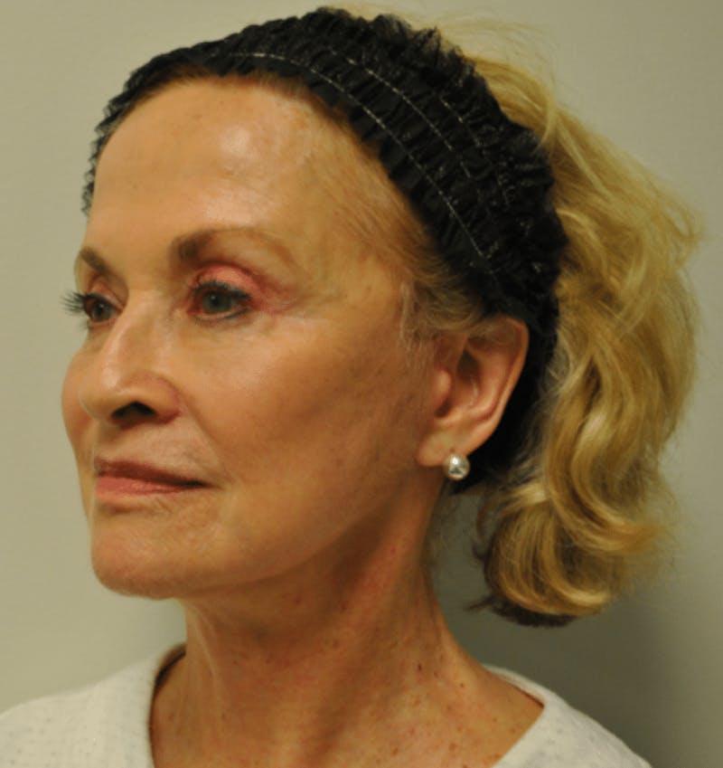 Surgical Lip Lift Before & After Gallery - Patient 922089 - Image 4