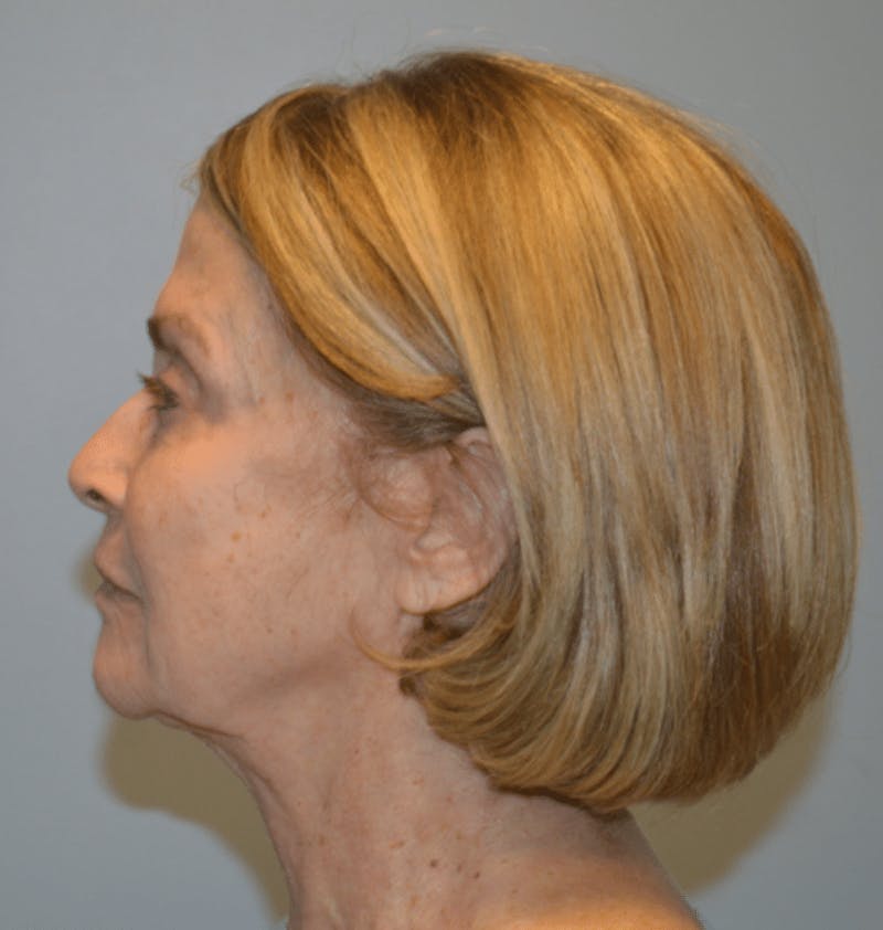 Surgical Lip Lift Before & After Gallery - Patient 922089 - Image 5