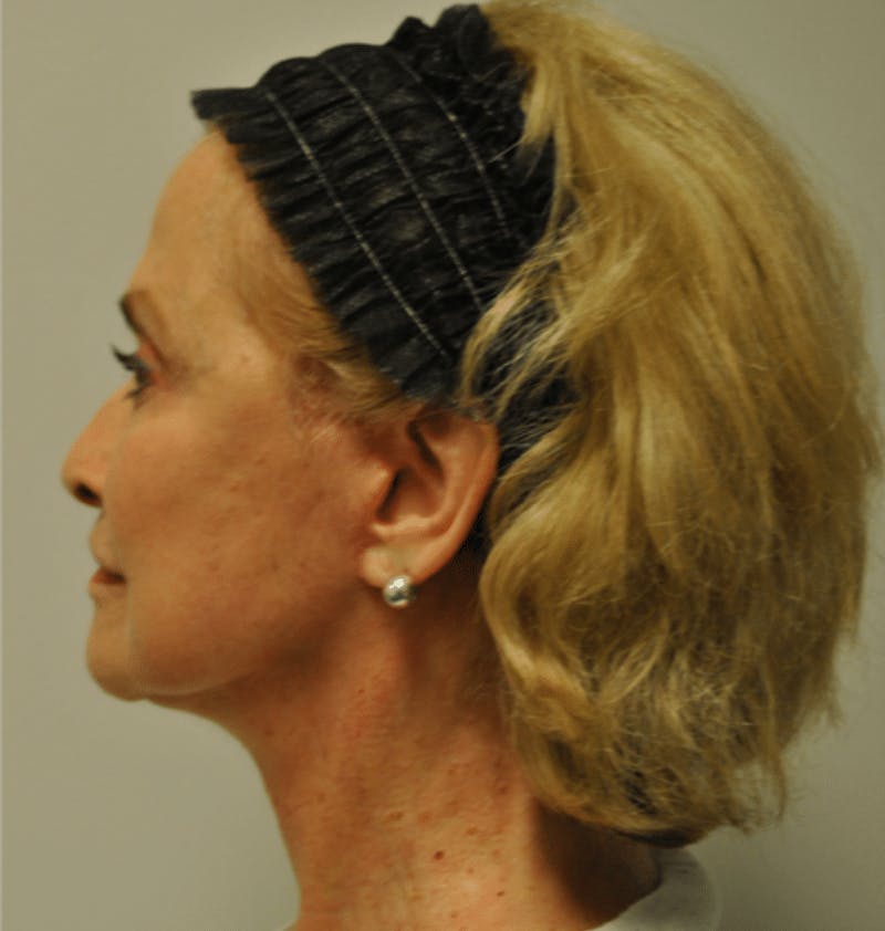 Surgical Lip Lift Before & After Gallery - Patient 922089 - Image 6