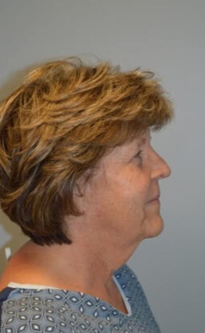 Facelift & Neck Lift Before & After Gallery - Patient 185259 - Image 1