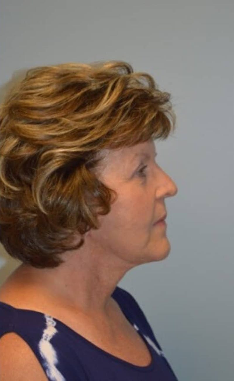 Facelift & Neck Lift Before & After Gallery - Patient 185259 - Image 2
