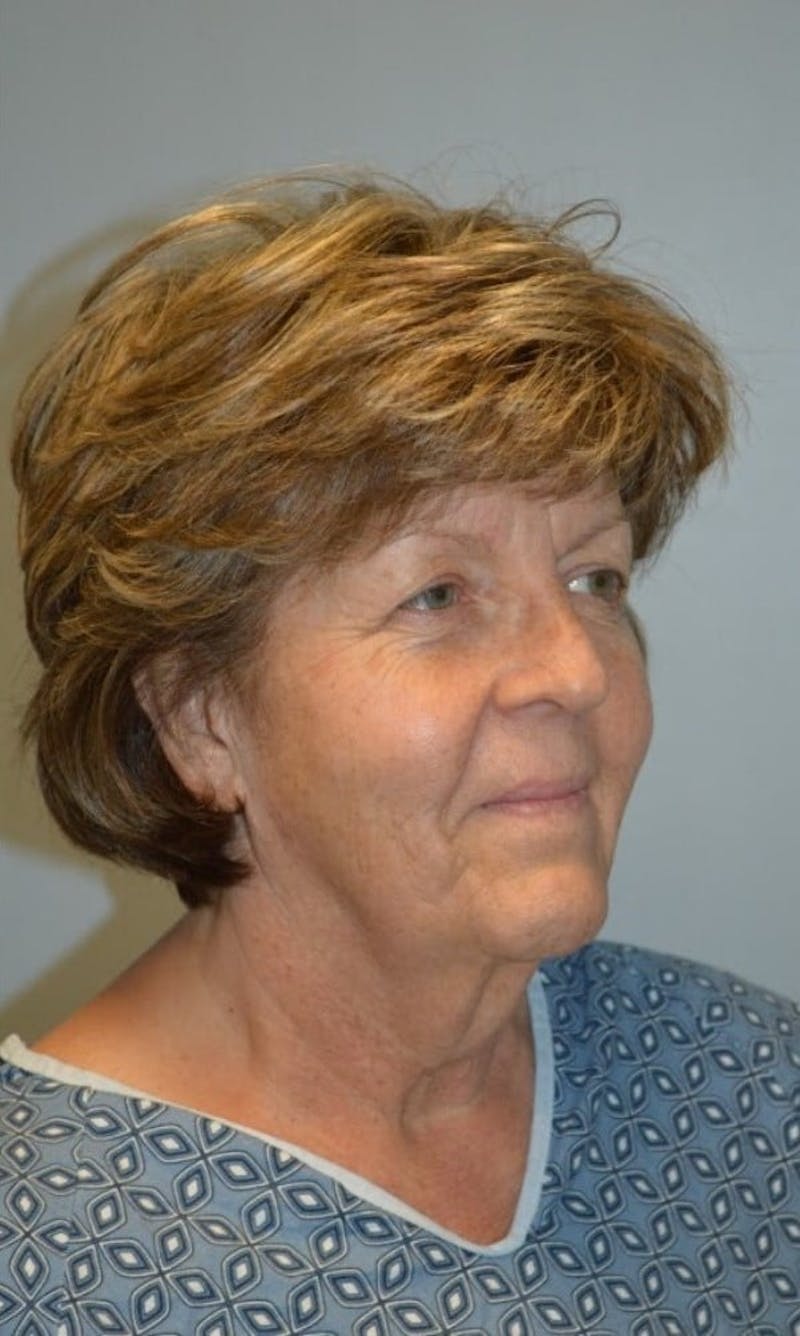 Facelift & Neck Lift Before & After Gallery - Patient 185259 - Image 3