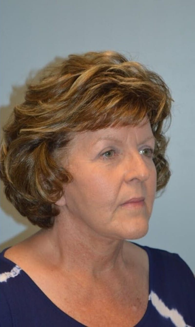 Facelift & Neck Lift Before & After Gallery - Patient 185259 - Image 4