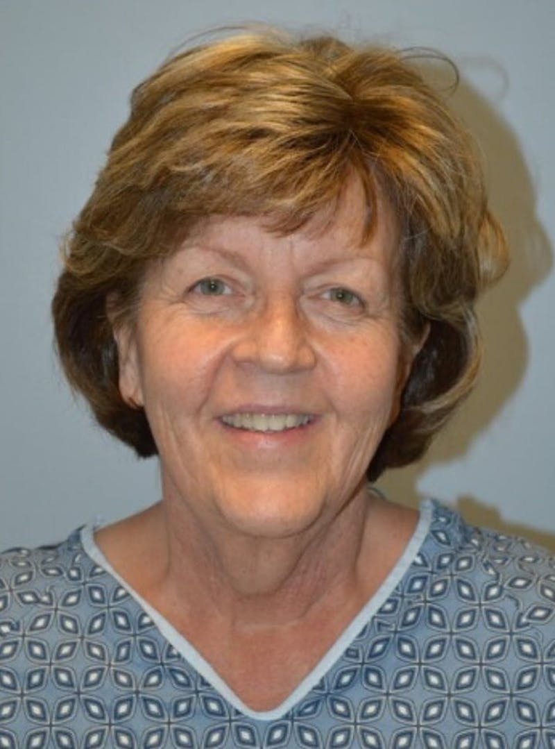 Facelift & Neck Lift Before & After Gallery - Patient 185259 - Image 5