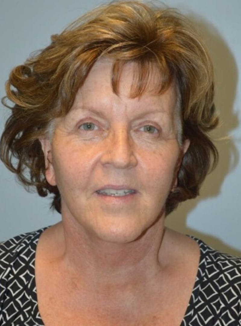 Facelift & Neck Lift Before & After Gallery - Patient 185259 - Image 6