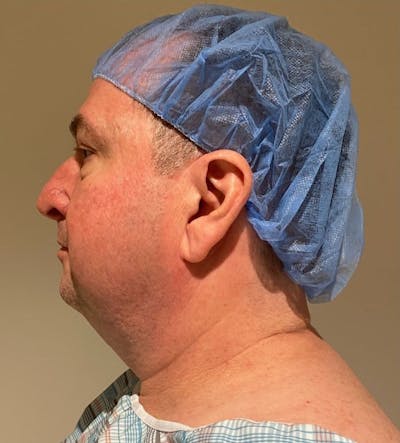 Neck Liposuction with Skin Tightening (Renuvion) Before & After Gallery - Patient 405927 - Image 1