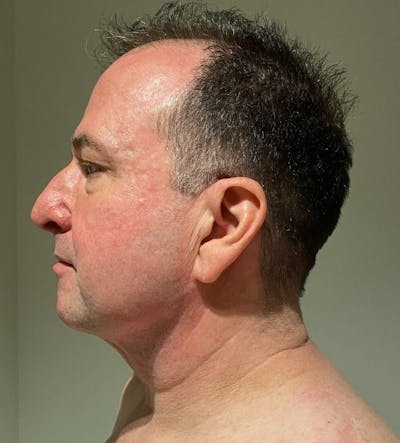 Neck Liposuction with Skin Tightening (Renuvion) Before & After Gallery - Patient 405927 - Image 2