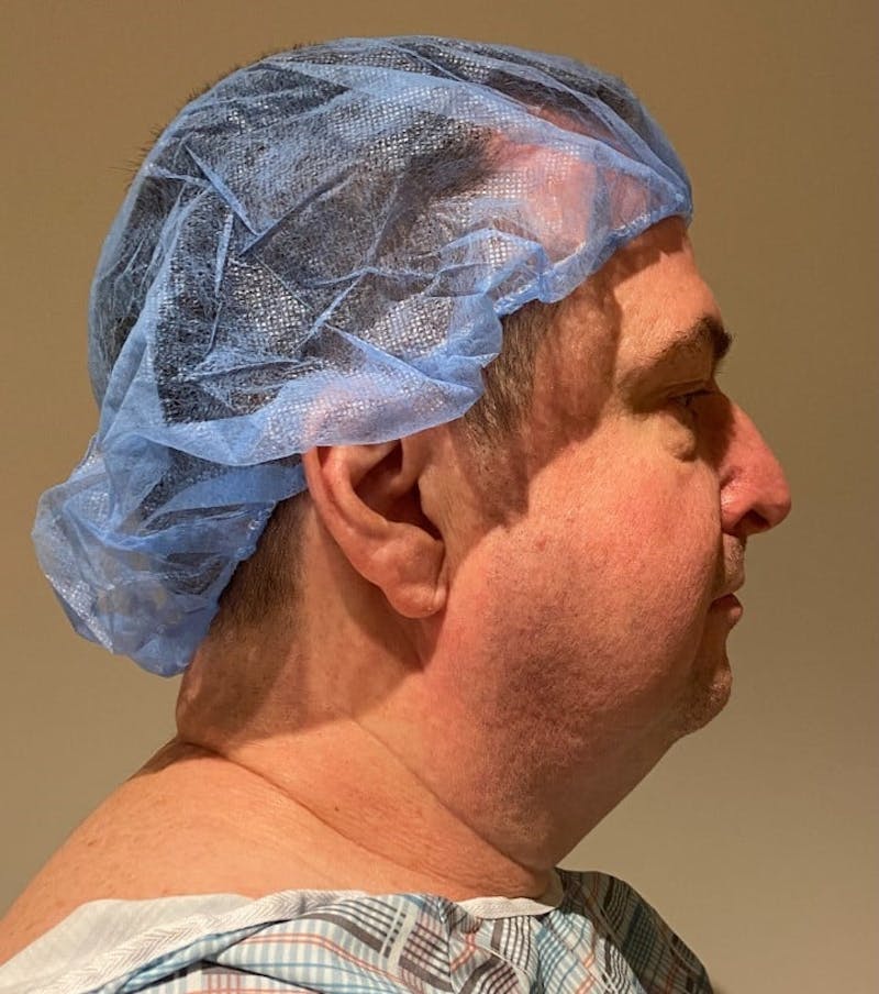 Neck Liposuction with Skin Tightening (Renuvion) Before & After Gallery - Patient 405927 - Image 3