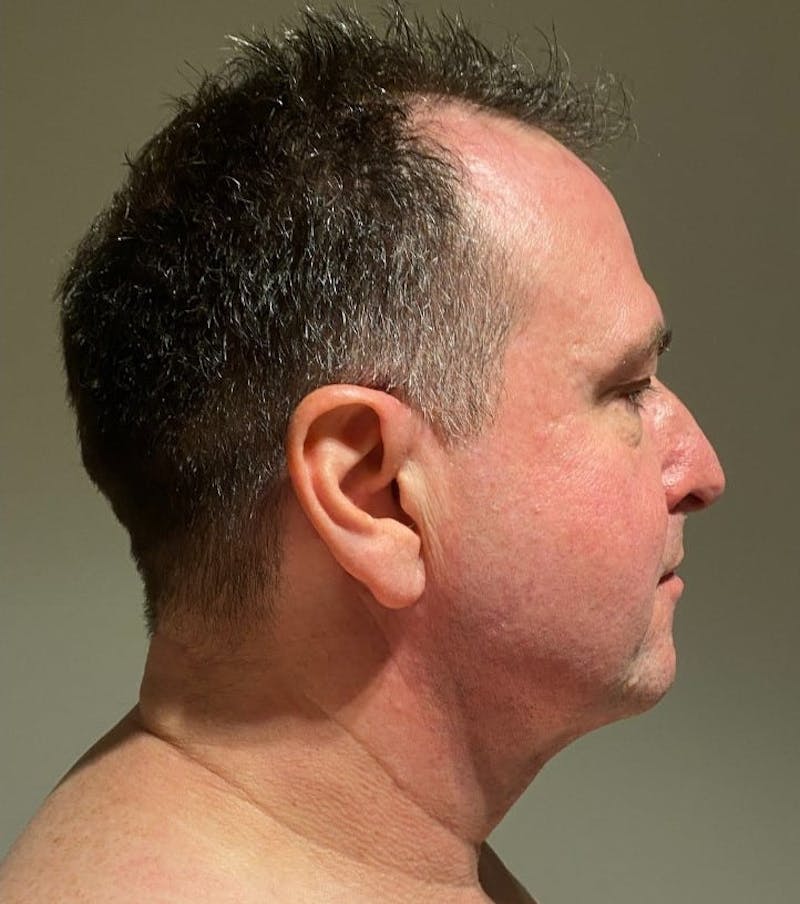 Neck Liposuction with Skin Tightening (Renuvion) Before & After Gallery - Patient 405927 - Image 4