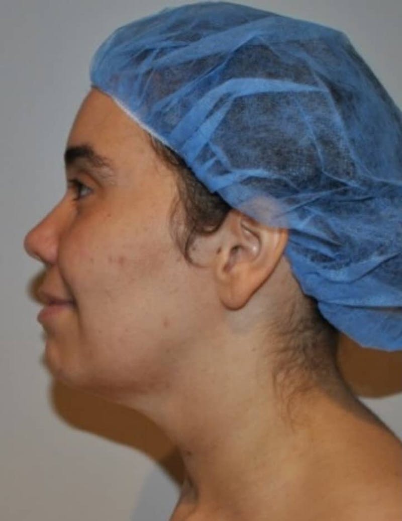 Neck Liposuction with Skin Tightening (Renuvion) Before & After Gallery - Patient 164253 - Image 1