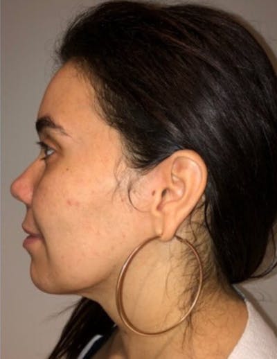 Neck Liposuction with Skin Tightening (Renuvion) Before & After Gallery - Patient 164253 - Image 2