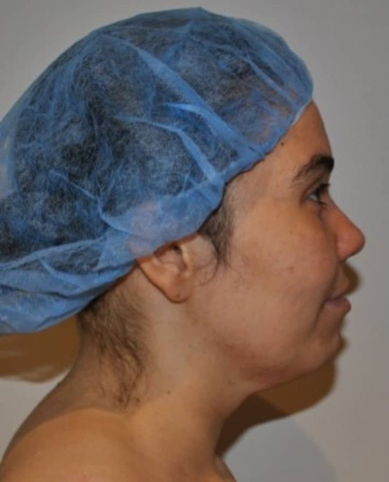 Neck Liposuction with Skin Tightening (Renuvion) Before & After Gallery - Patient 164253 - Image 3