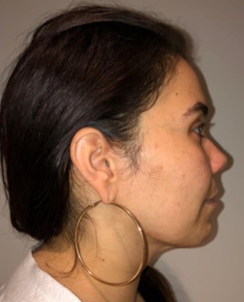 Neck Liposuction with Skin Tightening (Renuvion) Before & After Gallery - Patient 164253 - Image 4