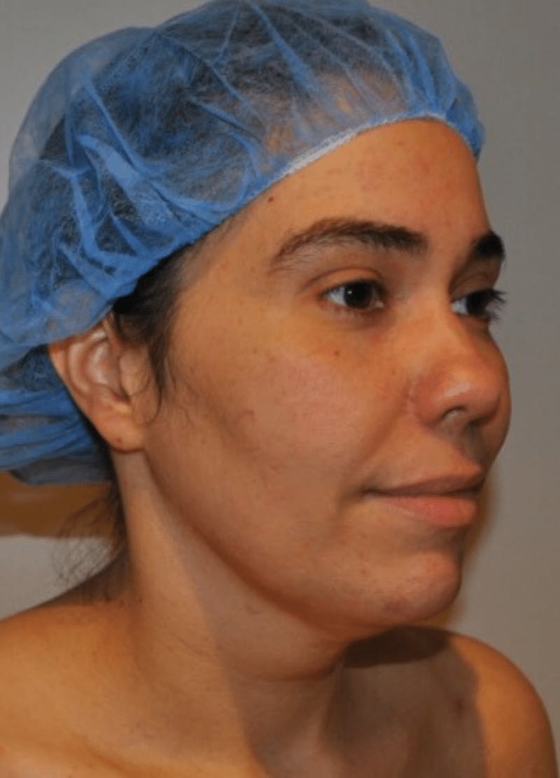 Neck Liposuction with Skin Tightening (Renuvion) Before & After Gallery - Patient 164253 - Image 5