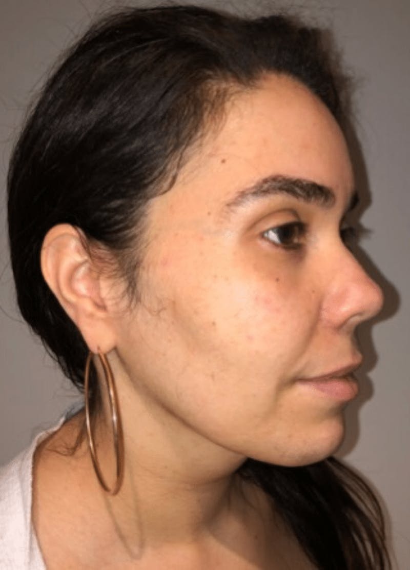 Neck Liposuction with Skin Tightening (Renuvion) Before & After Gallery - Patient 164253 - Image 6