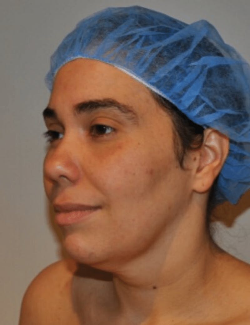Neck Liposuction with Skin Tightening (Renuvion) Before & After Gallery - Patient 164253 - Image 7