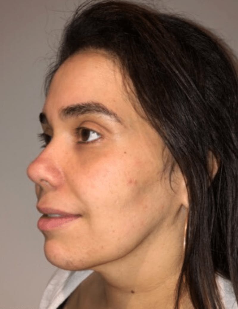 Neck Liposuction with Skin Tightening (Renuvion) Before & After Gallery - Patient 164253 - Image 8