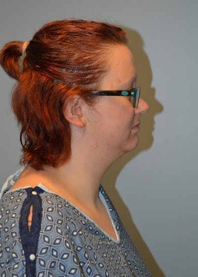 Neck Liposuction with Skin Tightening (Renuvion) Before & After Gallery - Patient 424356 - Image 1
