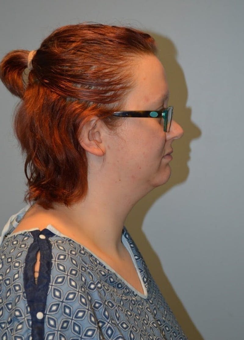 Neck Liposuction with Skin Tightening (Renuvion) Before & After Gallery - Patient 424356 - Image 1