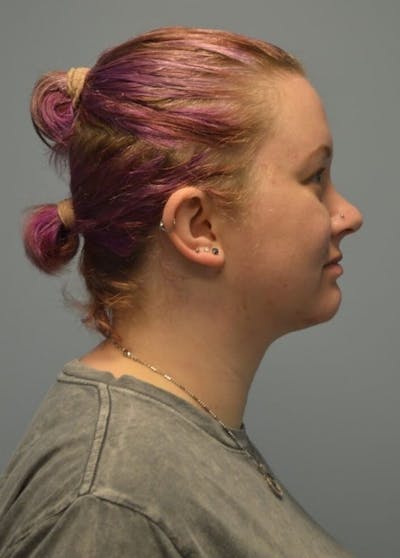 Neck Liposuction with Skin Tightening (Renuvion) Before & After Gallery - Patient 424356 - Image 2
