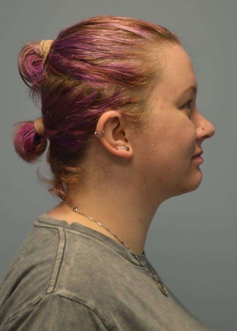 Neck Liposuction with Skin Tightening (Renuvion) Before & After Gallery - Patient 424356 - Image 2