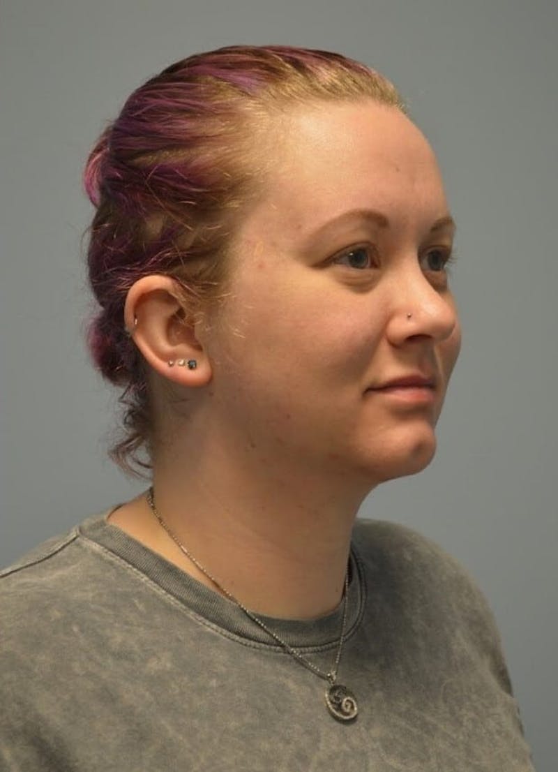 Neck Liposuction with Skin Tightening (Renuvion) Before & After Gallery - Patient 424356 - Image 4