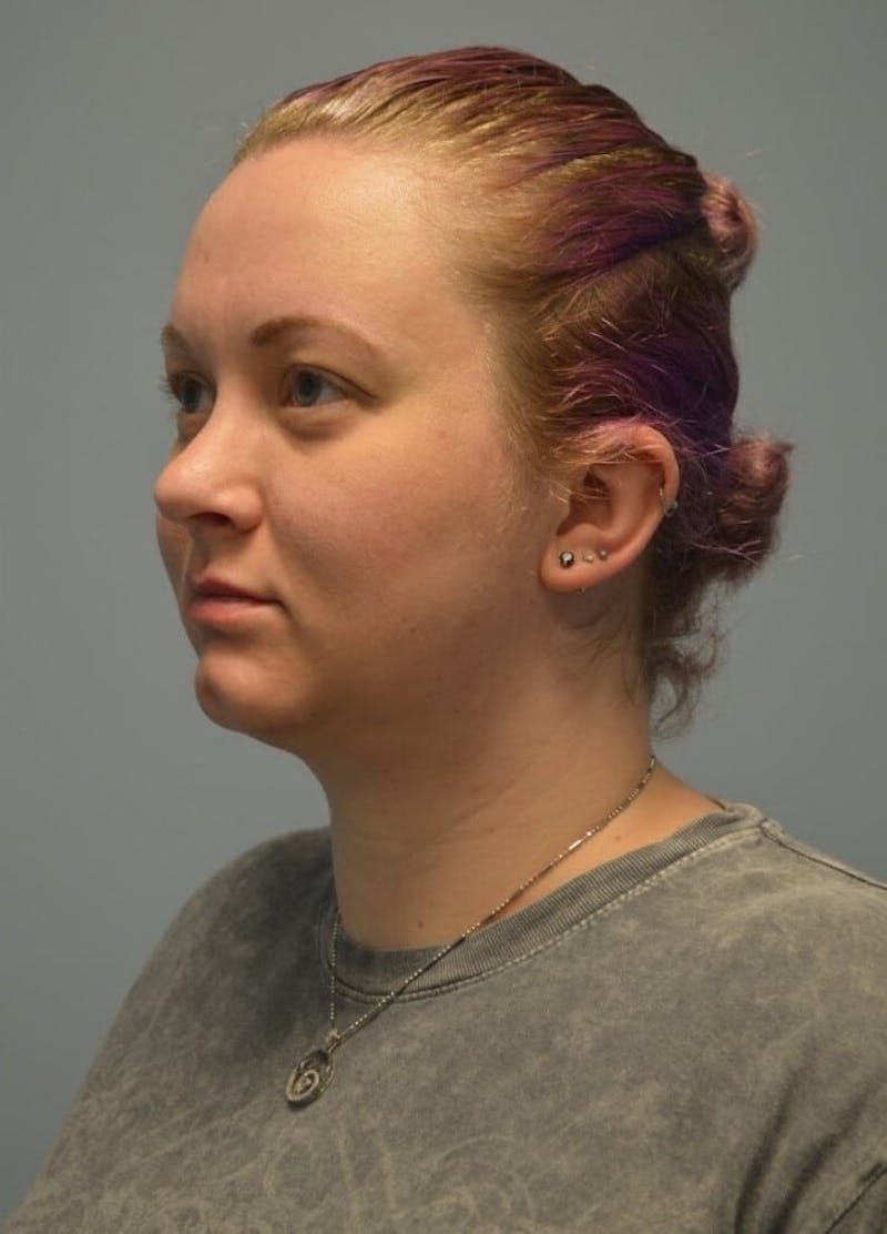 Neck Liposuction with Skin Tightening (Renuvion) Before & After Gallery - Patient 424356 - Image 6