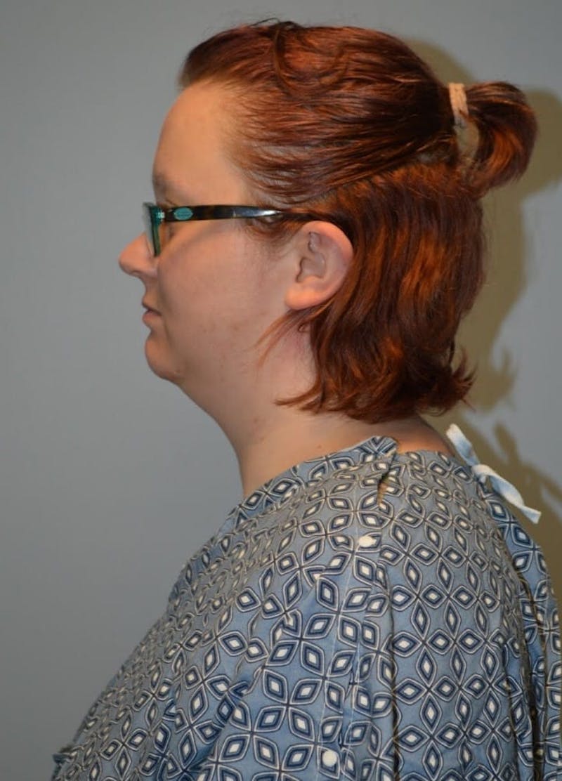 Neck Liposuction with Skin Tightening (Renuvion) Before & After Gallery - Patient 424356 - Image 7