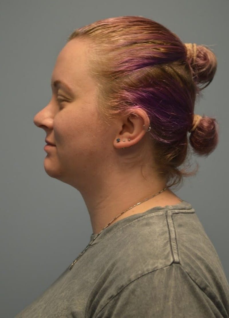 Neck Liposuction with Skin Tightening (Renuvion) Before & After Gallery - Patient 424356 - Image 8