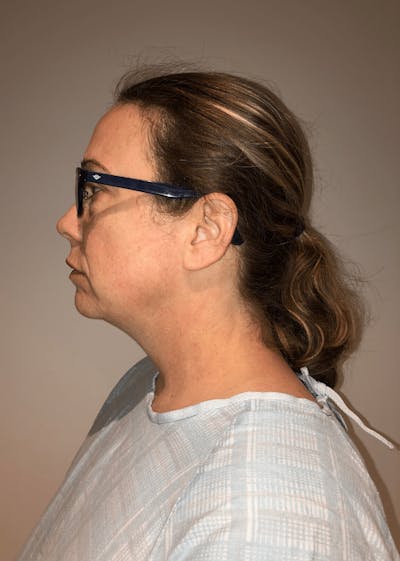 Neck Liposuction with Skin Tightening (Renuvion) Before & After Gallery - Patient 221683 - Image 1