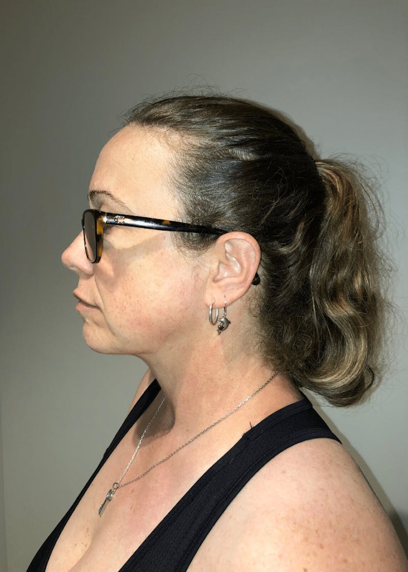 Neck Liposuction with Skin Tightening (Renuvion) Before & After Gallery - Patient 221683 - Image 2