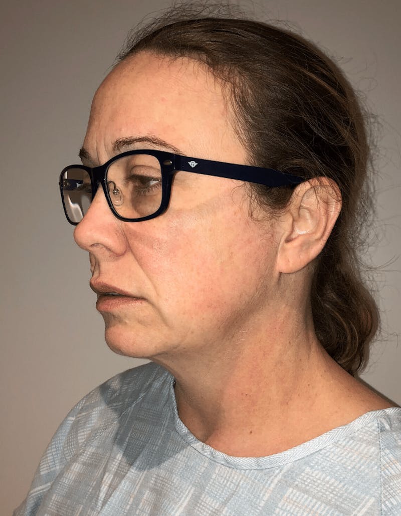 Neck Liposuction with Skin Tightening (Renuvion) Before & After Gallery - Patient 221683 - Image 3