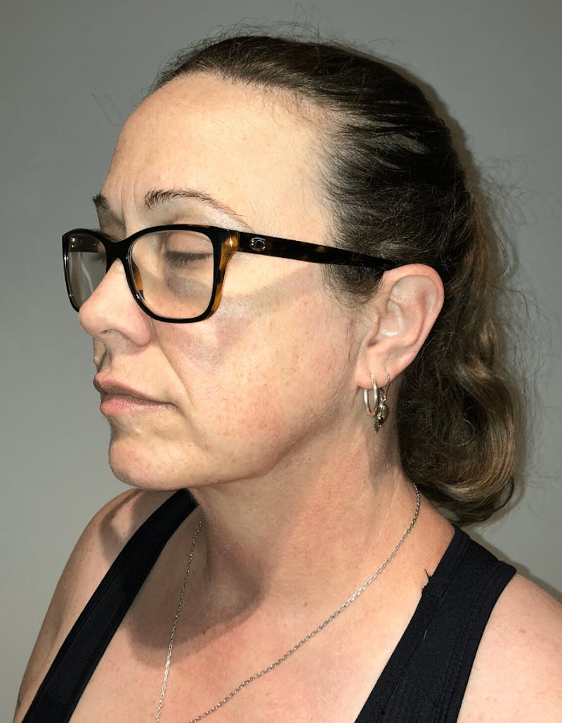 Neck Liposuction with Skin Tightening (Renuvion) Before & After Gallery - Patient 221683 - Image 4