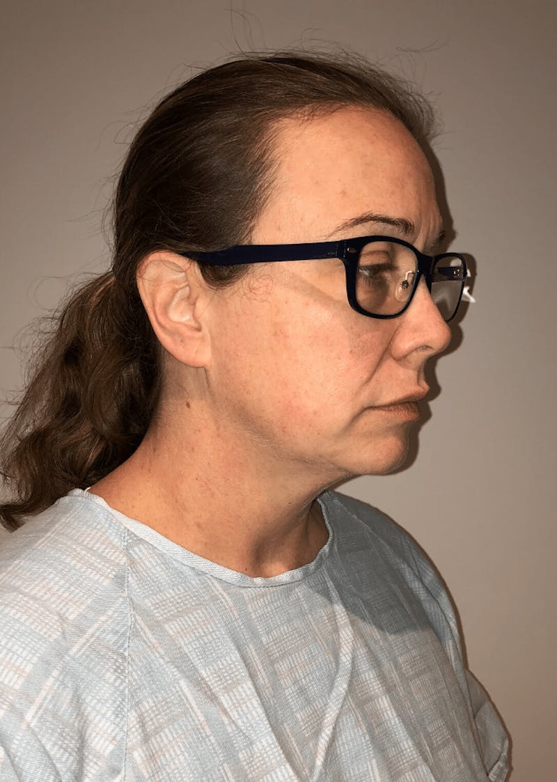 Neck Liposuction with Skin Tightening (Renuvion) Before & After Gallery - Patient 221683 - Image 5
