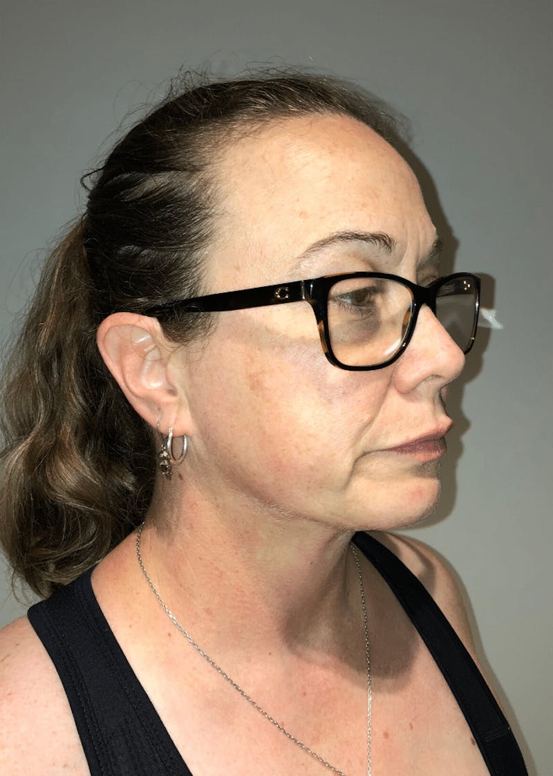Neck Liposuction with Skin Tightening (Renuvion) Before & After Gallery - Patient 221683 - Image 6