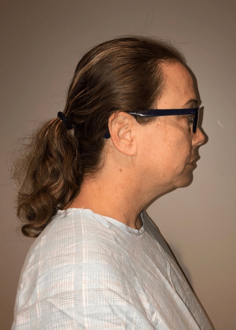 Neck Liposuction with Skin Tightening (Renuvion) Before & After Gallery - Patient 221683 - Image 7