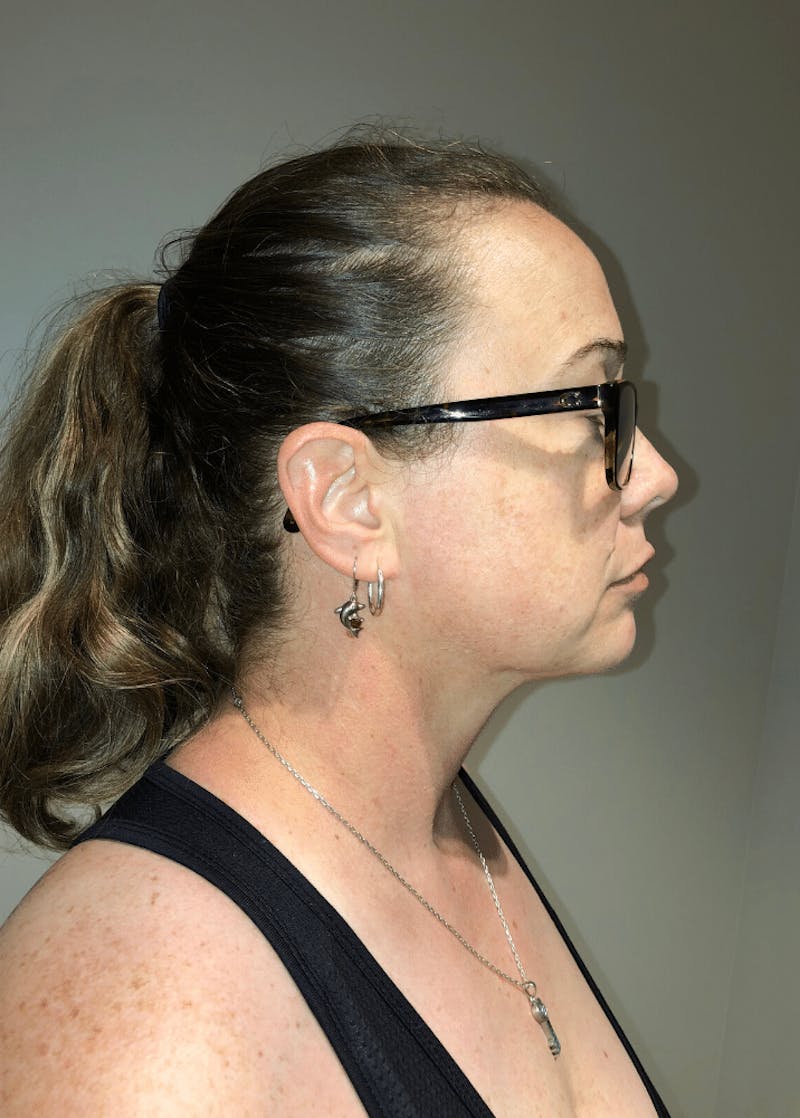 Neck Liposuction with Skin Tightening (Renuvion) Before & After Gallery - Patient 221683 - Image 8