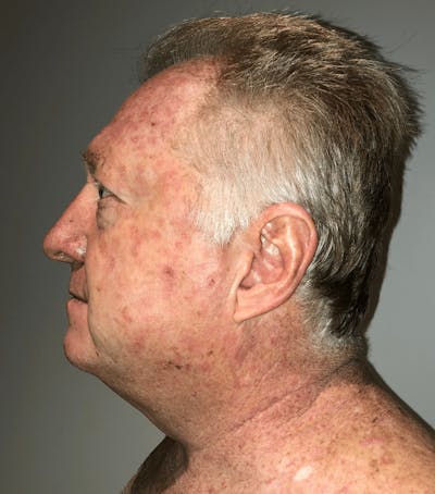 Neck Liposuction with Skin Tightening (Renuvion) Before & After Gallery - Patient 382987 - Image 1