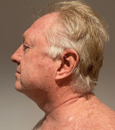 Neck Liposuction with Skin Tightening (Renuvion) Before & After Gallery - Patient 382987 - Image 2