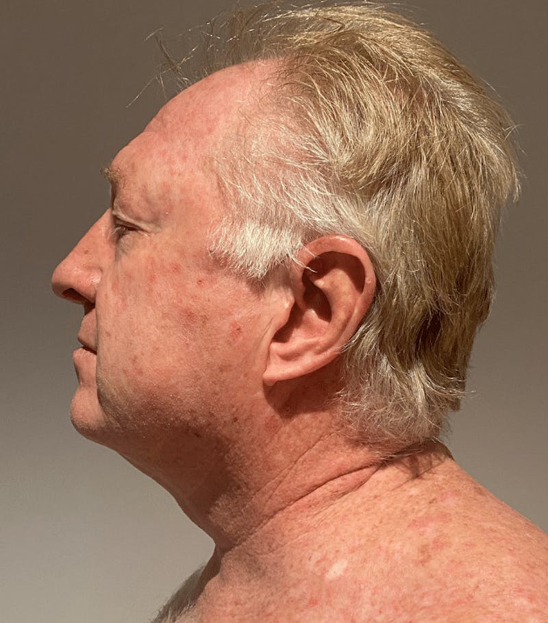 Neck Liposuction with Skin Tightening (Renuvion) Before & After Gallery - Patient 382987 - Image 2
