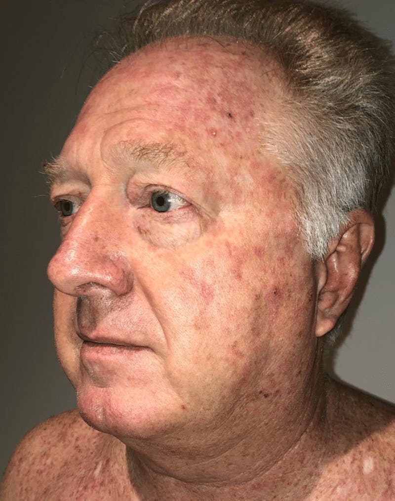 Neck Liposuction with Skin Tightening (Renuvion) Before & After Gallery - Patient 382987 - Image 3