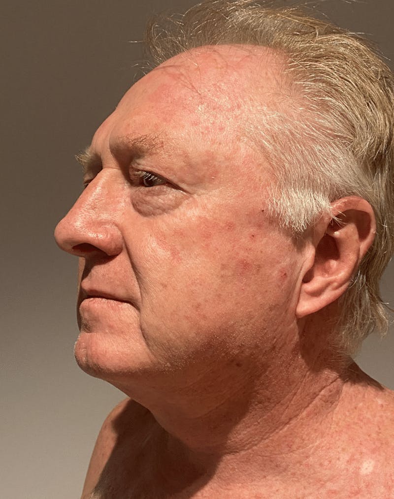 Neck Liposuction with Skin Tightening (Renuvion) Before & After Gallery - Patient 382987 - Image 4