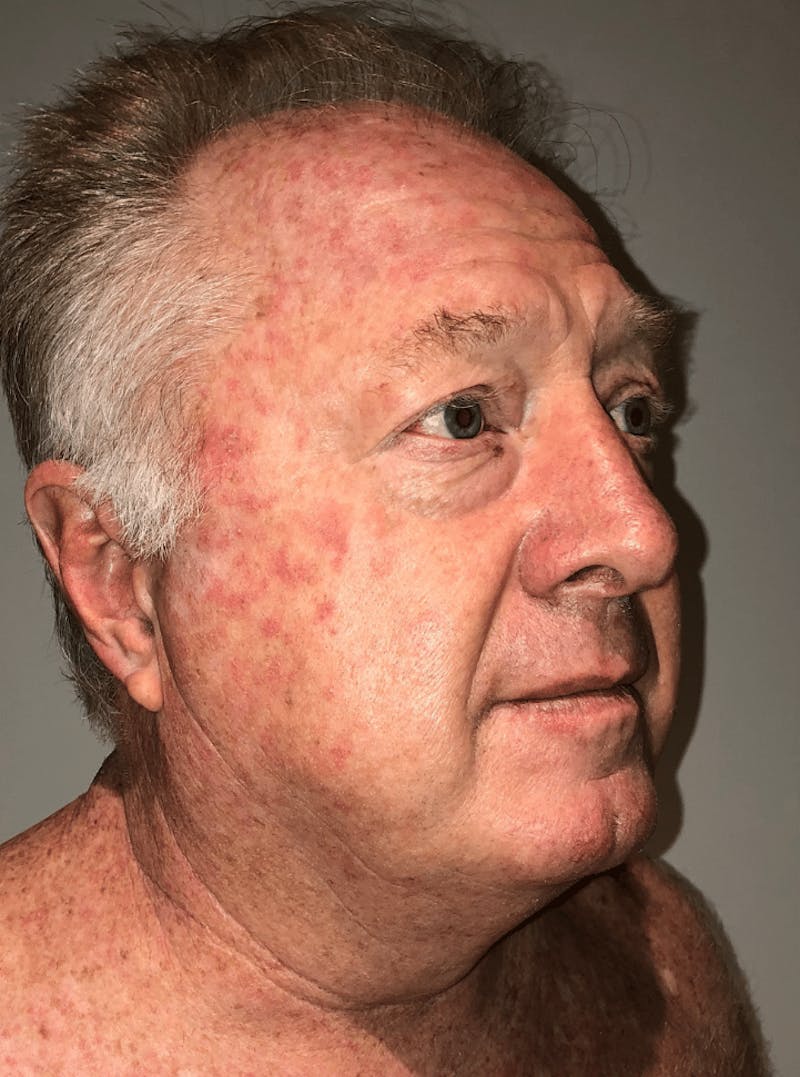 Neck Liposuction with Skin Tightening (Renuvion) Before & After Gallery - Patient 382987 - Image 5