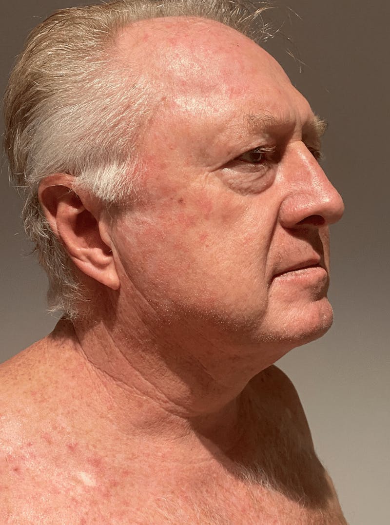 Neck Liposuction with Skin Tightening (Renuvion) Before & After Gallery - Patient 382987 - Image 6