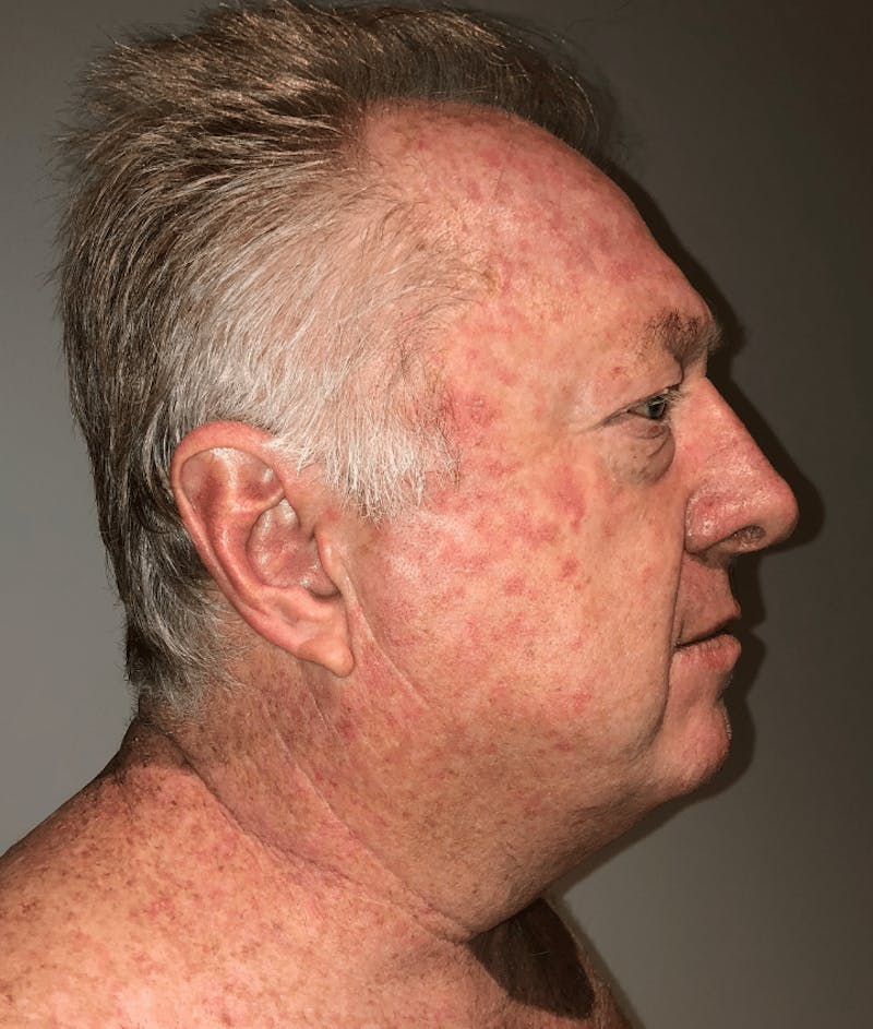 Neck Liposuction with Skin Tightening (Renuvion) Before & After Gallery - Patient 382987 - Image 7